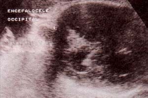 Encefalocele occipital