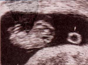 Corte longitudinal 10 semanas .