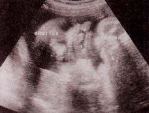 Labio leporino bilateral 