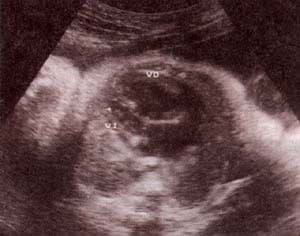 Síndrome de ventrículo izquierdo hipoplásico