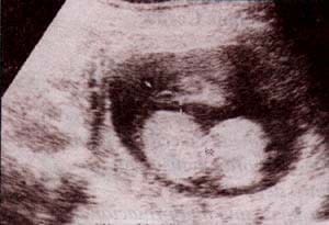 Onfalocele y Gastrosquisis