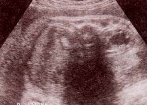 Dilataciones pélvicas renales