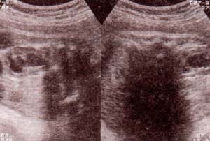 Dilataciones pélvicas renales