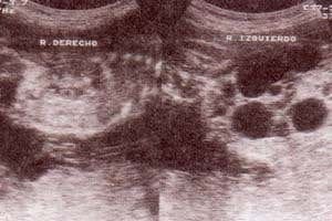 Displasia Renal Multiquística