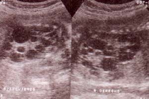 Múltiples Quistes y Riñones