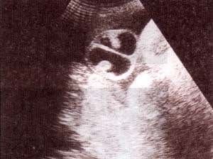 Hidrocele, gran distensión escrotal