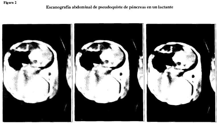 Escanografía abdominal pseudoquiste Escanografía abdominal pseudoquiste