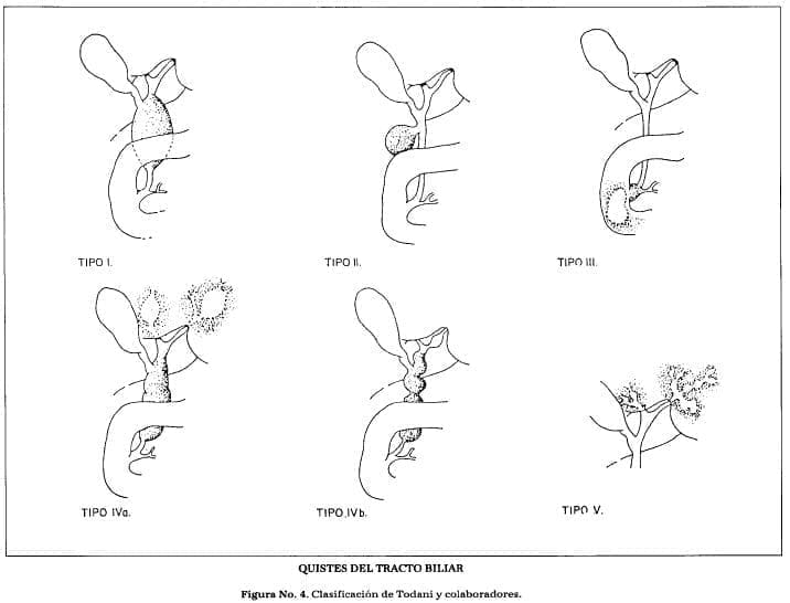 Quistes del tracto biliar