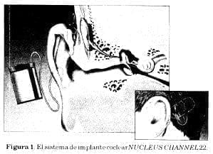 Sistema implante coclear Sistema implante coclear