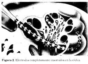 Electrodos implantados Electrodos implantados