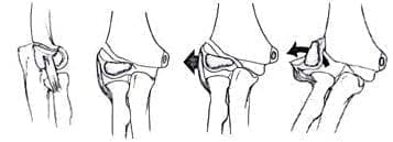 Desplazamiento de la fractura en 5 tipos Desplazamiento de la fractura en 5 tipos
