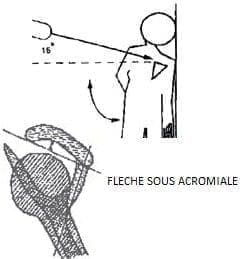 Incidencia lateral Tendinopatías