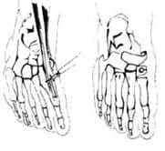 Tenotomia del tivial anterior perforación Tenotomia del tivial anterior perforación
