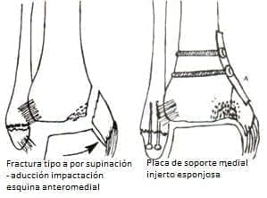 Fracturas con placa de soporte e injertos óseos