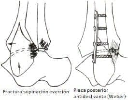 Fijación de fracturas oblícuas cortas con placa posterior Fijación de fracturas oblícuas cortas con placa posterior