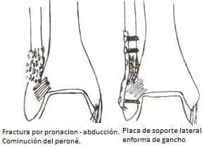 Reducción indirecta con una placa de soporte lateral Reducción indirecta con una placa de soporte lateral