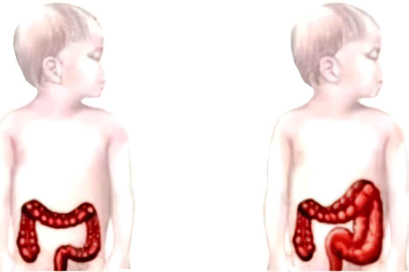 Tratamiento de la Enfermedad de Hirschsprung