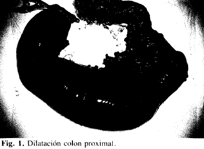 Dilatación colon proximal Dilatación colon proximal