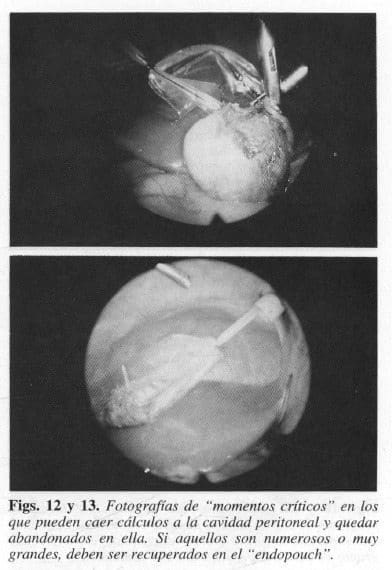"Momentos Críticos" en los que pueden caer cálculos a la cavidad peritoneal "Momentos Críticos" en los que pueden caer cálculos a la cavidad peritoneal