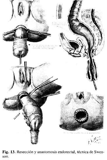 Resección y anastomosis endorectal, técnica de Swenson