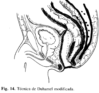 Técnica de Duhamel modificada. Técnica de Duhamel modificada