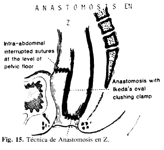 Técnica de Anastomosis en Z. Técnica de Anastomosis en Z