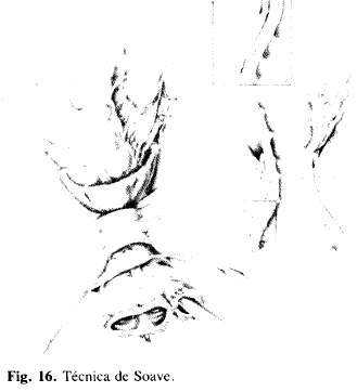 Técnica de Soave Técnica de Soave