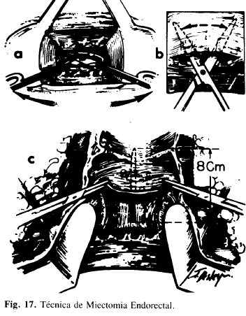 Técnica de Miectomia Endorectal Técnica de Miectomia Endorectal