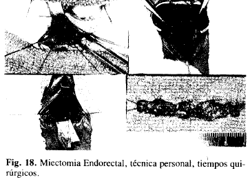 Miectomia Endorectal, técnica personal, tiempos quirúrgicos Miectomia Endorectal, técnica personal, tiempos quirúrgicos