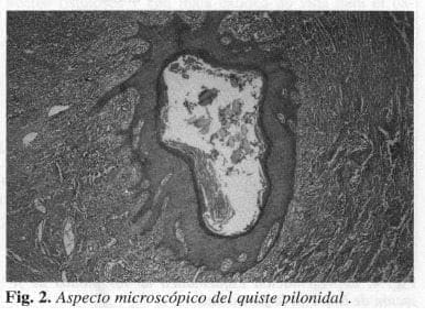 Aspecto microscópico del quiste pilonidal Aspecto microscópico del quiste pilonidal