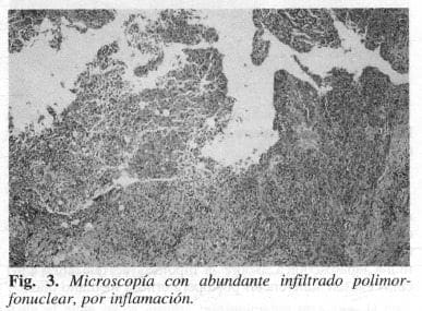 Microscopía con abundante infiltrado polimorfonuclear, por inflamación Microscopía con abundante infiltrado polimorfonuclear, por inflamación