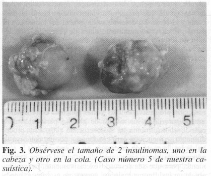 Insulinomas, uno en la cabeza y otro en la cola Insulinomas, uno en la cabeza y otro en la cola