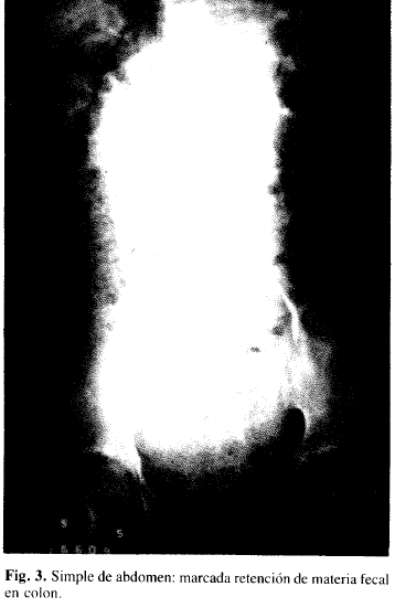 Simple de abdomen: marcada retención de materia fecal en colon Simple de abdomen: marcada retención de materia fecal en colon