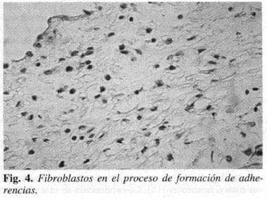 Fibroblastos en el proceso de formación de adherencias Fibroblastos en el proceso de formación de adherencias