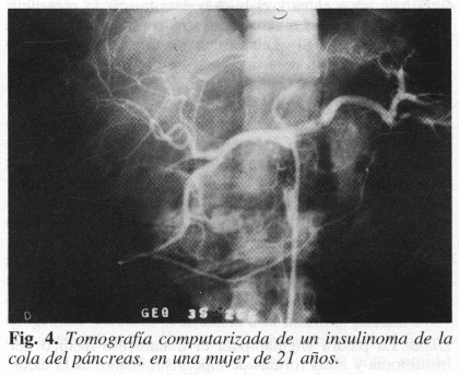 Tomografía computarizada de un insulinoma de la cola del páncreas Tomografía computarizada de un insulinoma de la cola del páncreas