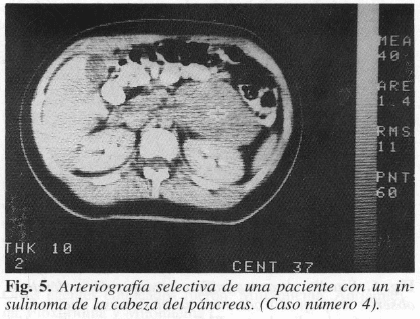 Arteriografía selectiva de paciente con un insulinoma de la cabeza del páncreas Arteriografía selectiva de paciente con un insulinoma de la cabeza del páncreas