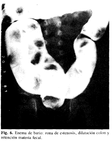 Enema de bario: zona de estenosis, dilatación colon y retención materia fecal Enema de bario: zona de estenosis, dilatación colon y retención materia fecal