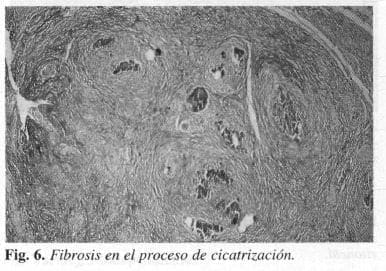 Fibrosis en el proceso de cicatrización Fibrosis en el proceso de cicatrización