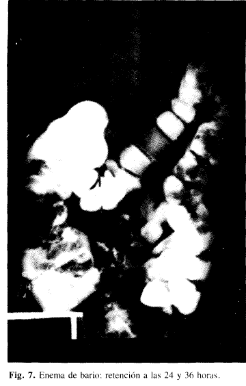 Enema de bario: retención a las 24 y 36 horas Enema de bario: retención a las 24 y 36 horas