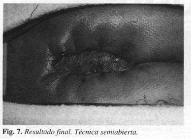 Técnica semiabierta Resultado final Técnica semiabierta Resultado final