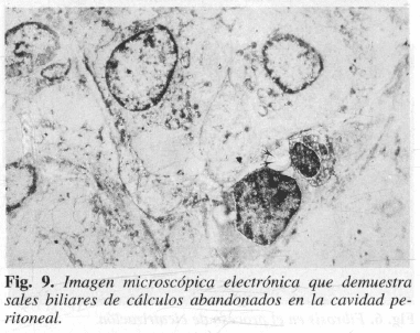 Sales biliares de cálculos abandonados en la cavidad peritoneal Sales biliares de cálculos abandonados en la cavidad peritoneal