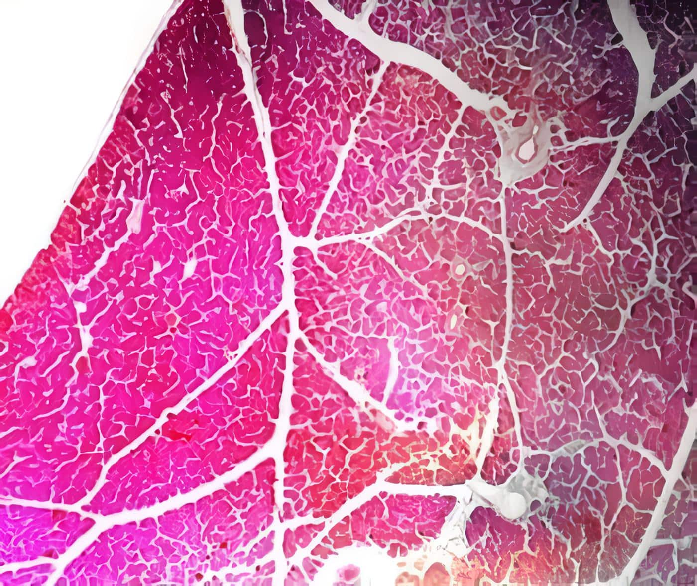 Insulinoma