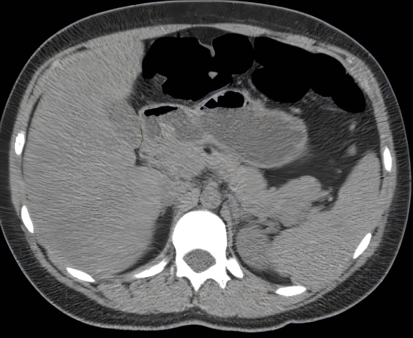 Discusión Insulinoma