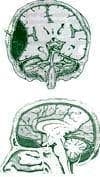 Hematoma Epidural Hematoma Epidural