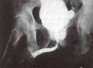 Estrechez de la uretra bulbar Estrechez de la uretra bulbar