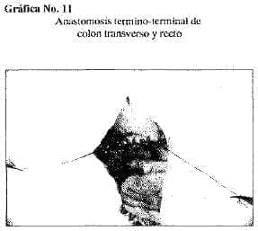 Anastomosis Anastomosis