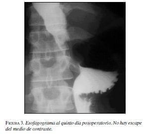 Esofagograma al quinto día posoperatorio