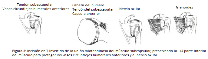 Incisión de T invertida en la unión miotendionosa