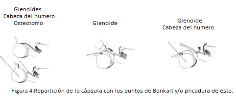 vol22-Figura 4 Repartición de la cápsula con los puntos de Bankart