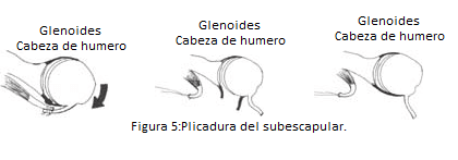 Plicadura del subescapular